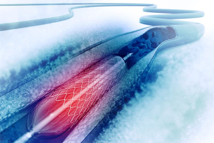 Angioplasty - Stenting